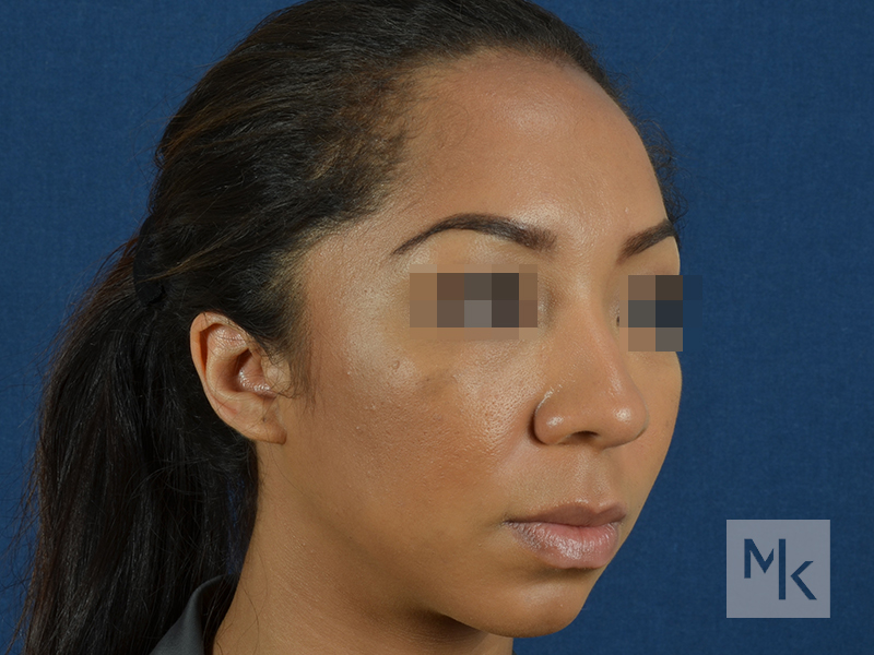 Ethnic Rhinoplasty Before and After | Dr. Michael Kim