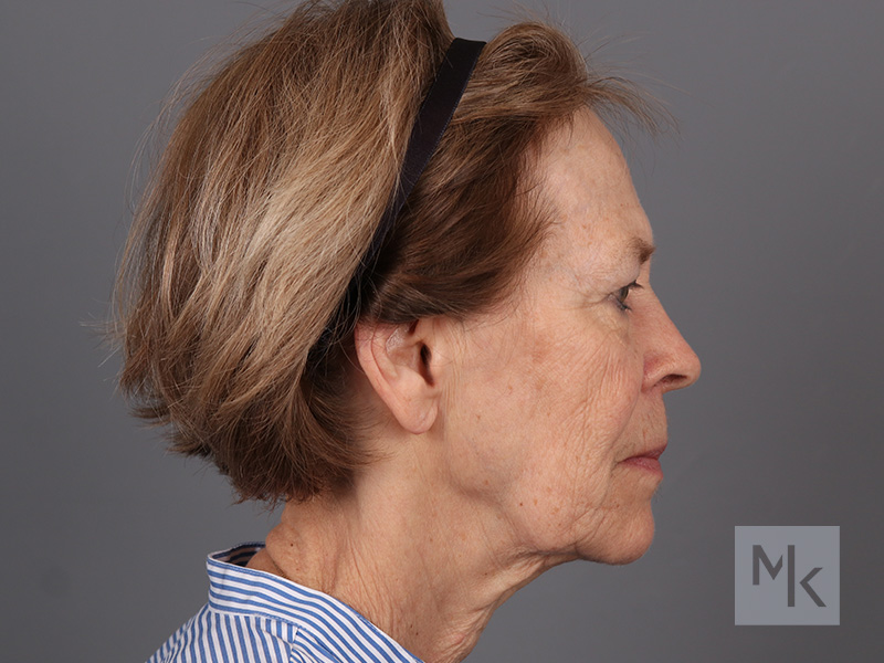 Facelift Before and After | Dr. Michael Kim