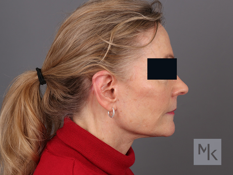 Facelift Before and After | Dr. Michael Kim