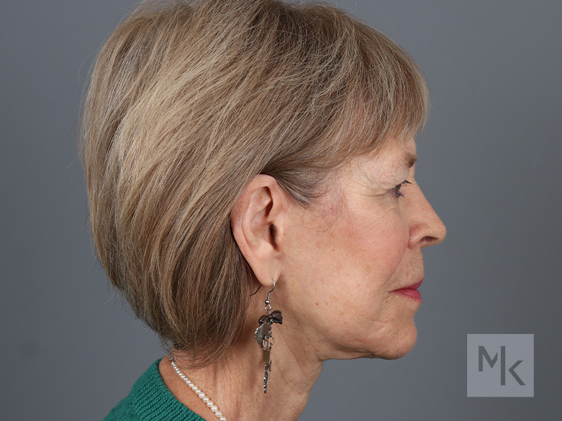 Facelift Before and After | Dr. Michael Kim