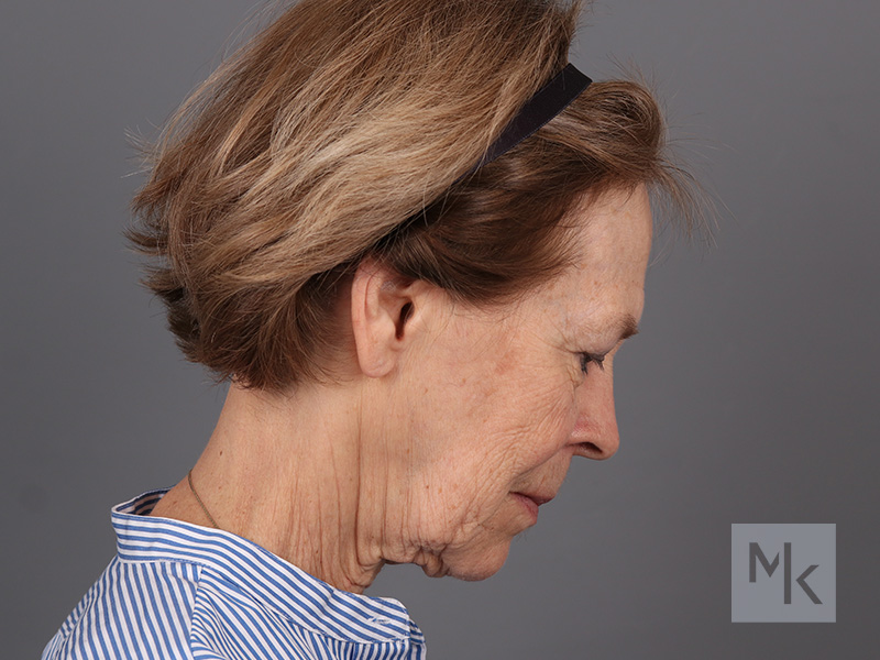 Facelift Before and After | Dr. Michael Kim
