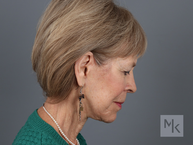 Facelift Before and After | Dr. Michael Kim
