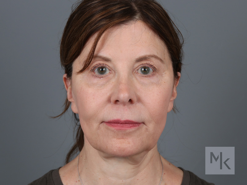 Facelift Before and After | Dr. Michael Kim