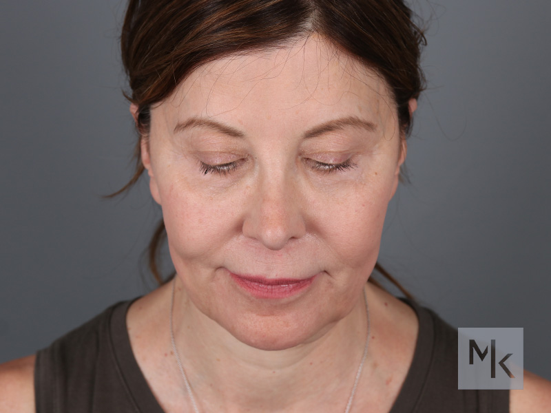 Facelift Before and After | Dr. Michael Kim