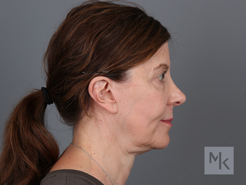 Facelift Before and After | Dr. Michael Kim