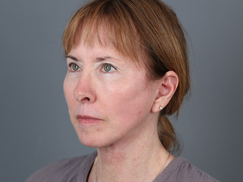 Facelift Before and After | Dr. Michael Kim