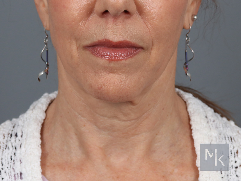 Facelift Before and After | Dr. Michael Kim