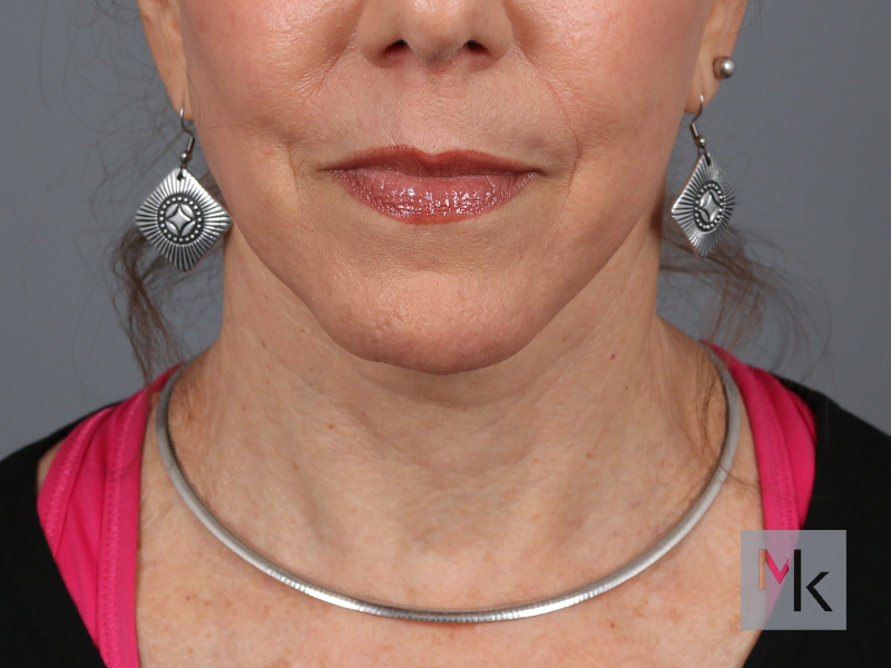 Facelift Before and After | Dr. Michael Kim