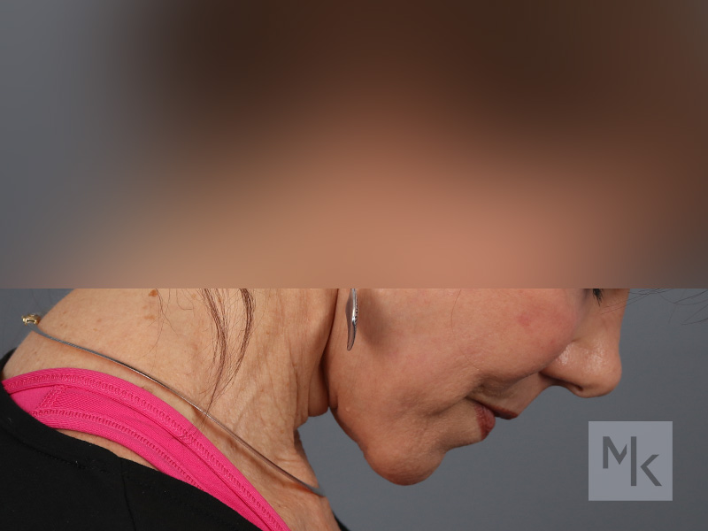 Facelift Before and After | Dr. Michael Kim