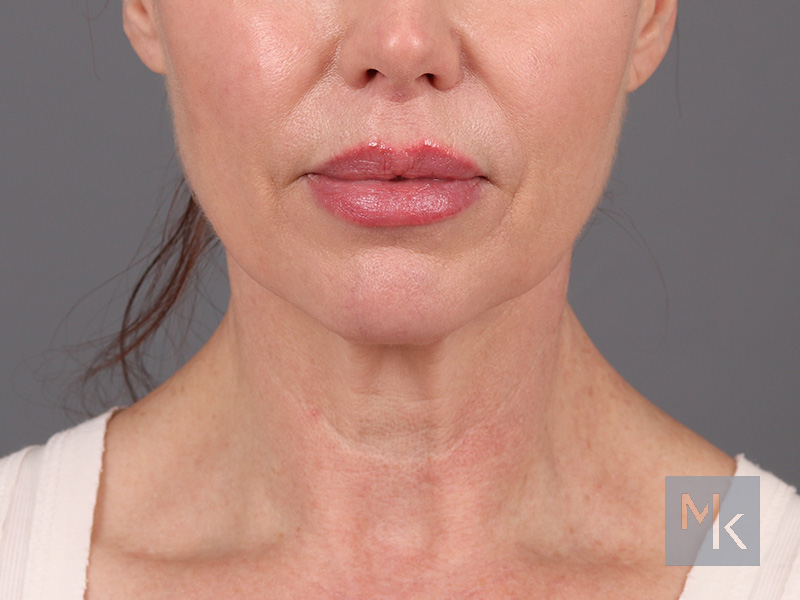 Facelift Before and After | Dr. Michael Kim