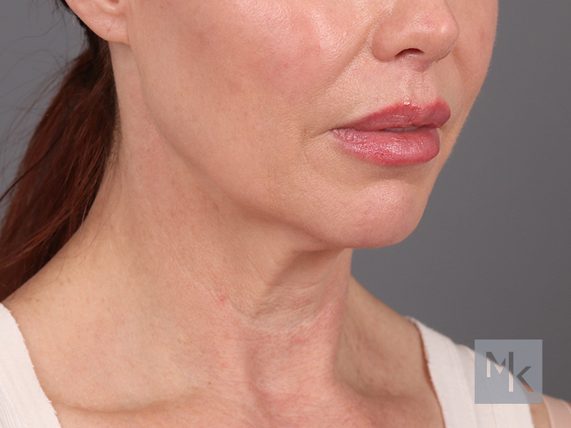 Facelift Before and After | Dr. Michael Kim