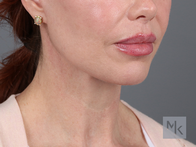 Facelift Before and After | Dr. Michael Kim