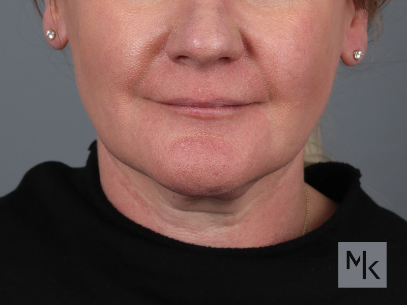 Facelift Before and After | Dr. Michael Kim