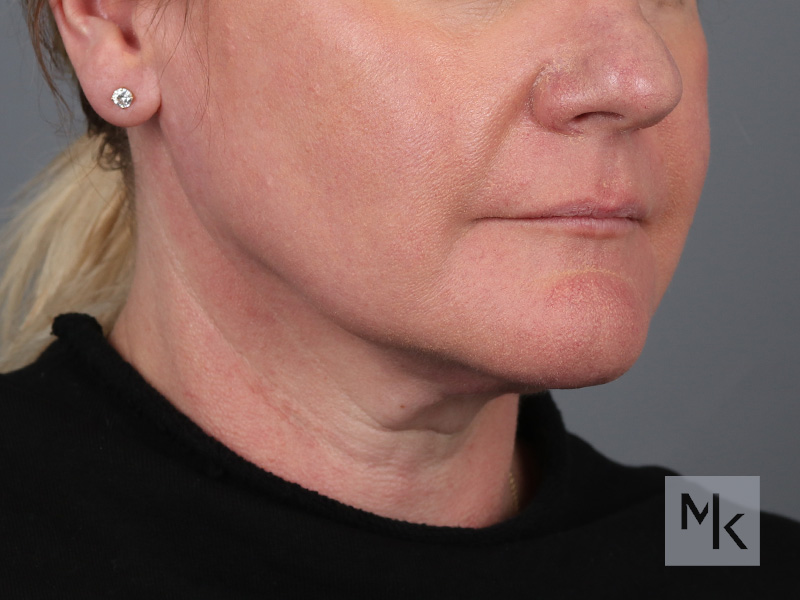 Facelift Before and After | Dr. Michael Kim