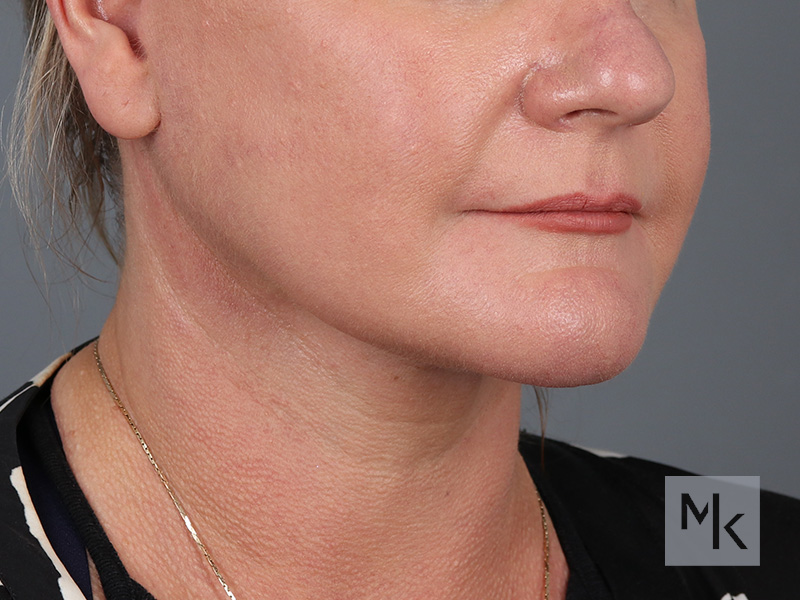 Facelift Before and After | Dr. Michael Kim