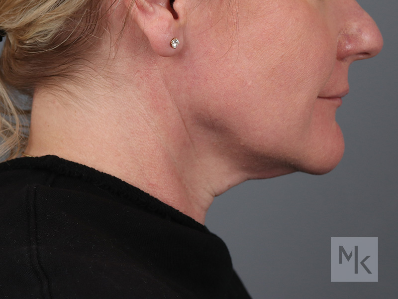 Facelift Before and After | Dr. Michael Kim