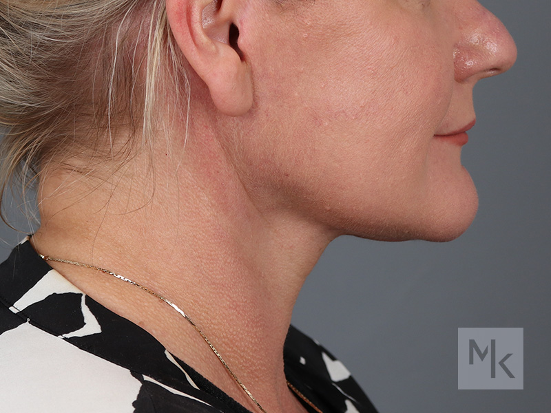 Facelift Before and After | Dr. Michael Kim