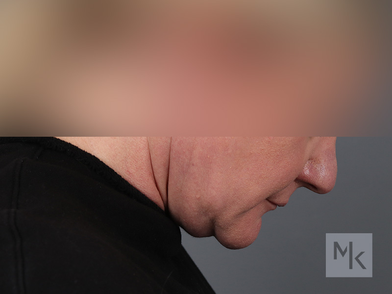 Facelift Before and After | Dr. Michael Kim