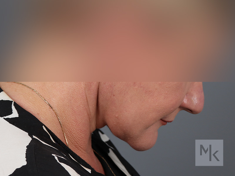 Facelift Before and After | Dr. Michael Kim