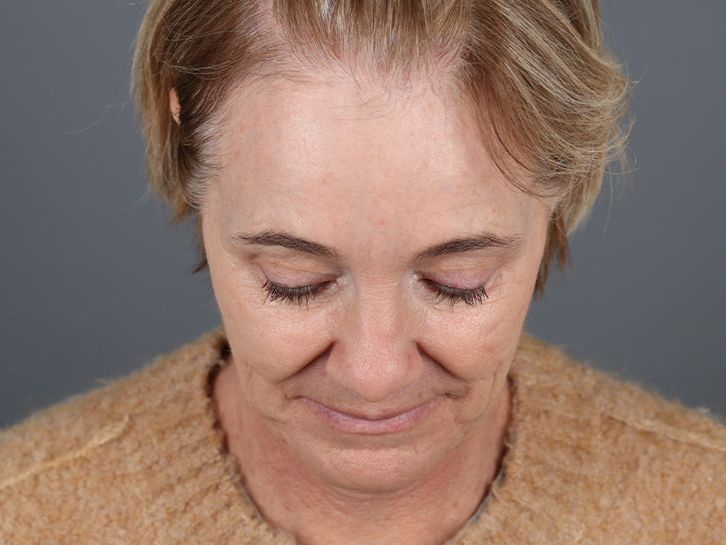 Facelift Before and After | Dr. Michael Kim