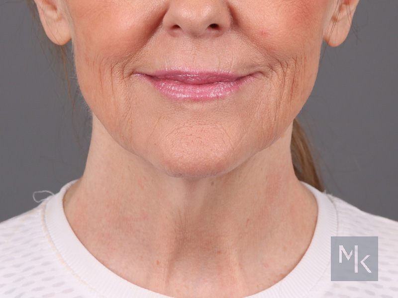 Facelift Before and After | Dr. Michael Kim