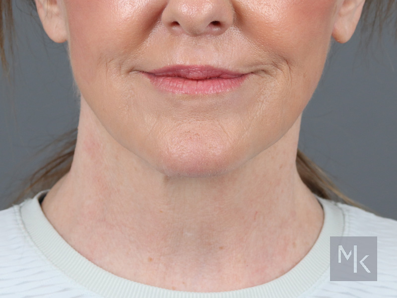 Facelift Before and After | Dr. Michael Kim