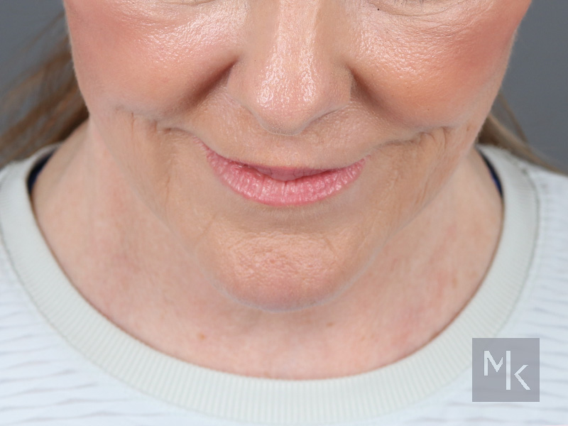 Facelift Before and After | Dr. Michael Kim