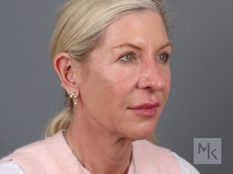 Facelift Before and After | Dr. Michael Kim