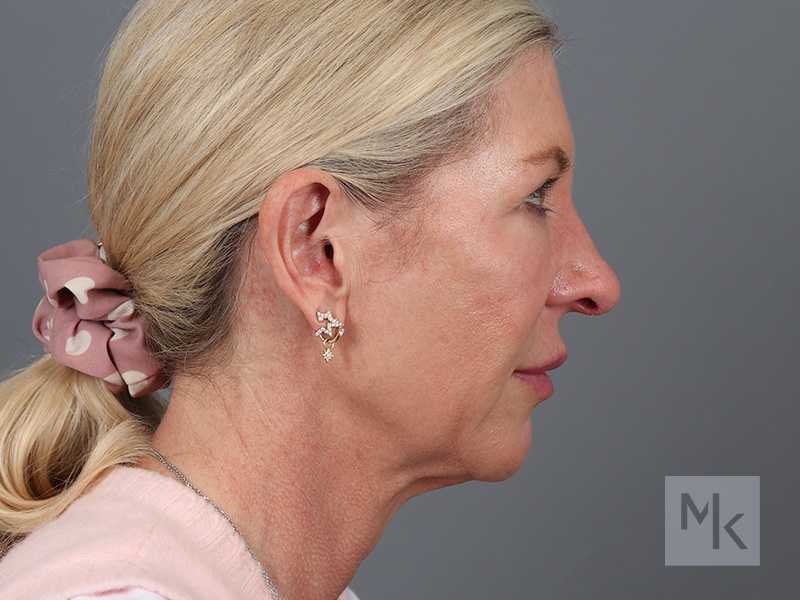 Facelift Before and After | Dr. Michael Kim