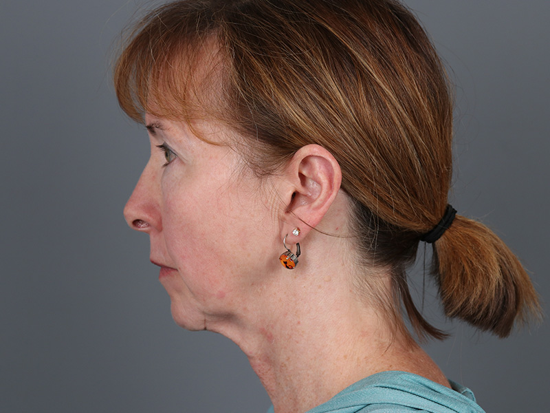 Facelift Before and After | Dr. Michael Kim