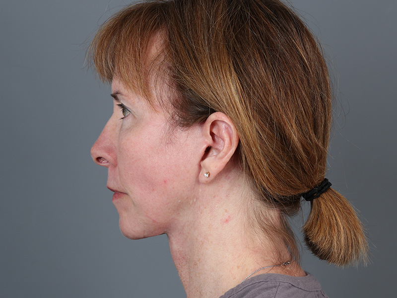 Facelift Before and After | Dr. Michael Kim