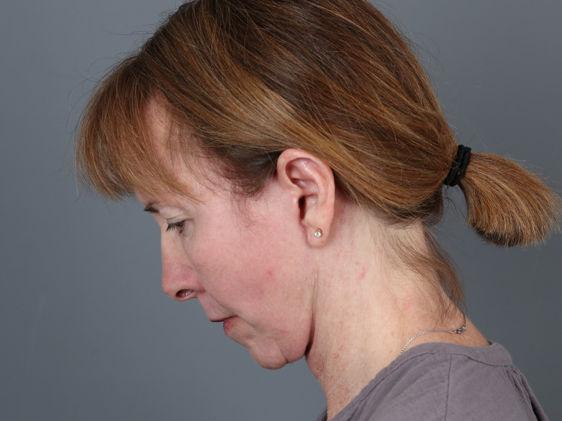 Facelift Before and After | Dr. Michael Kim