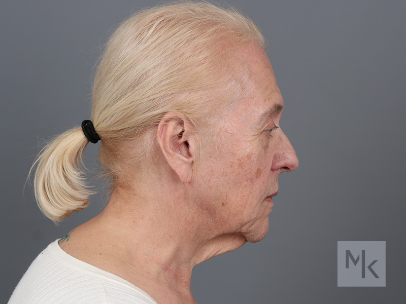 Facelift Before and After | Dr. Michael Kim