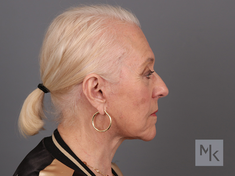 Facelift Before and After | Dr. Michael Kim