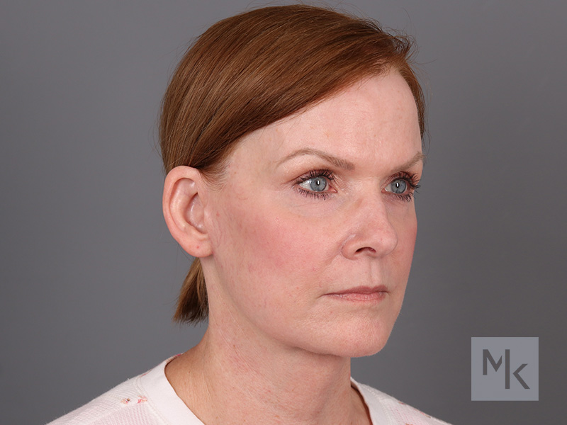 Facelift Before and After | Dr. Michael Kim