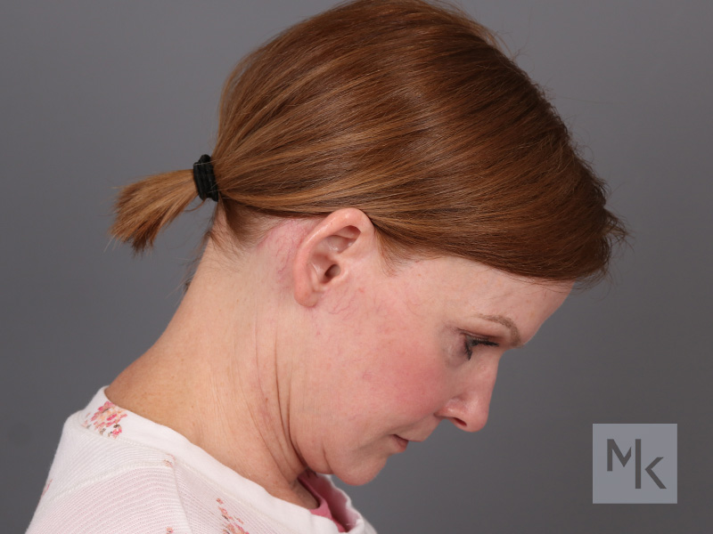 Facelift Before and After | Dr. Michael Kim