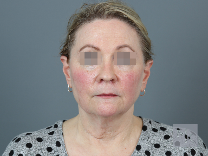 Facelift Before and After | Dr. Michael Kim