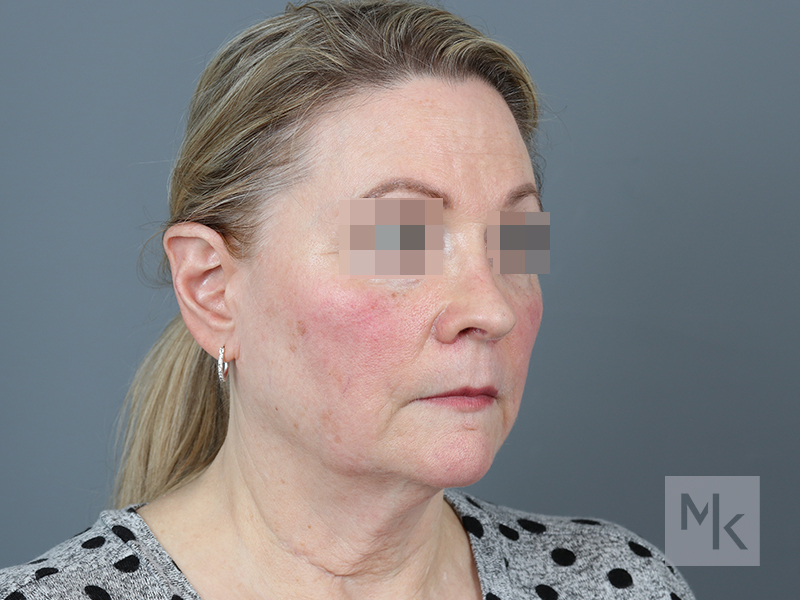 Facelift Before and After | Dr. Michael Kim