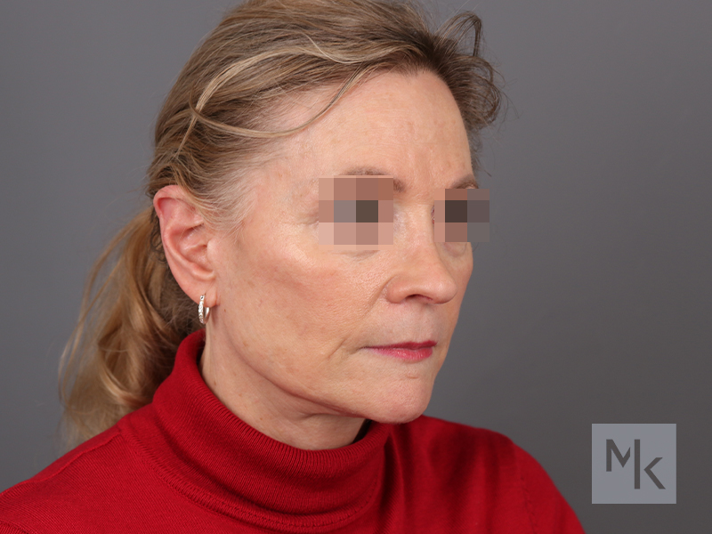 Facelift Before and After | Dr. Michael Kim