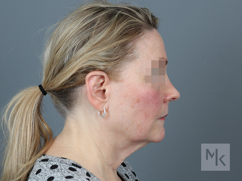 Facelift Before and After | Dr. Michael Kim