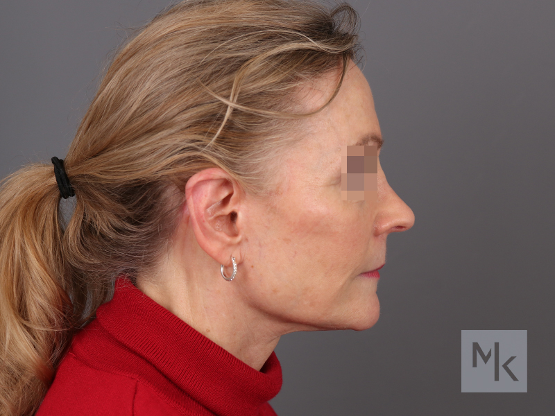 Facelift Before and After | Dr. Michael Kim