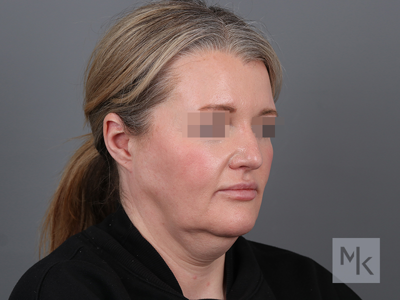 Facelift Before and After | Dr. Michael Kim