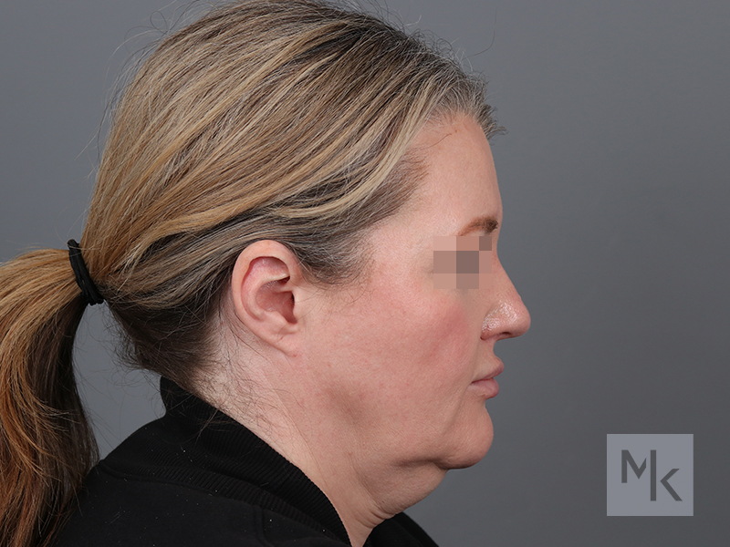 Facelift Before and After | Dr. Michael Kim