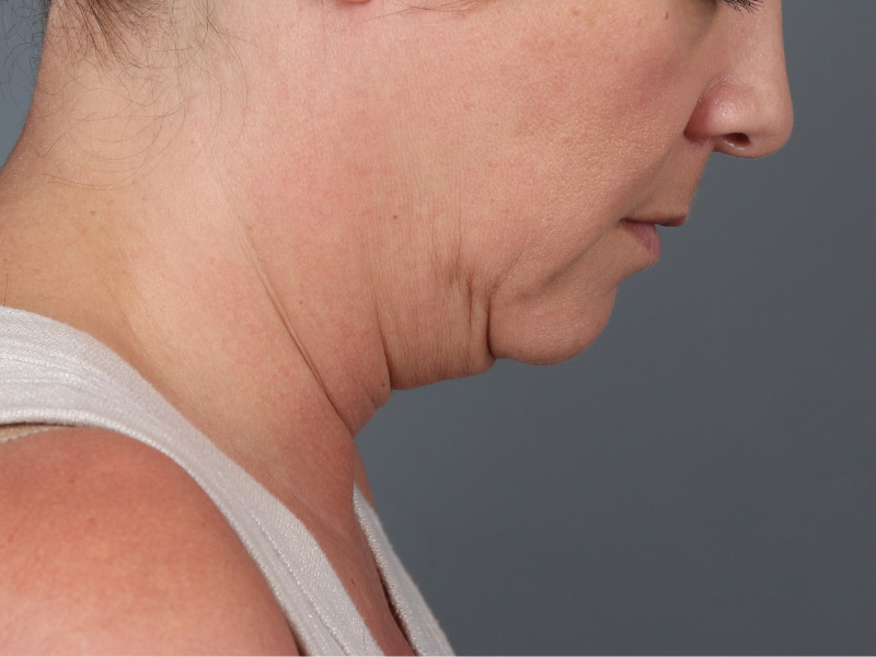 Facelift Before and After | Dr. Michael Kim