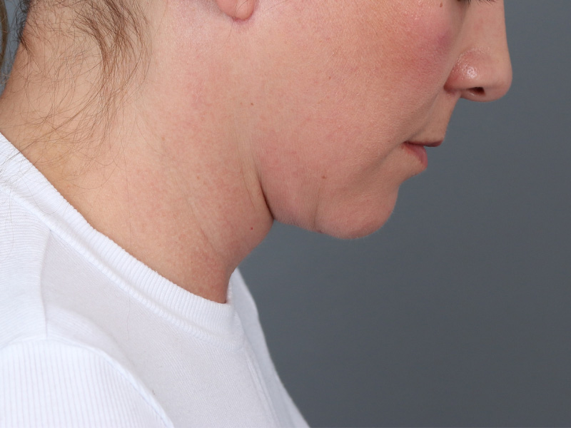 Facelift Before and After | Dr. Michael Kim