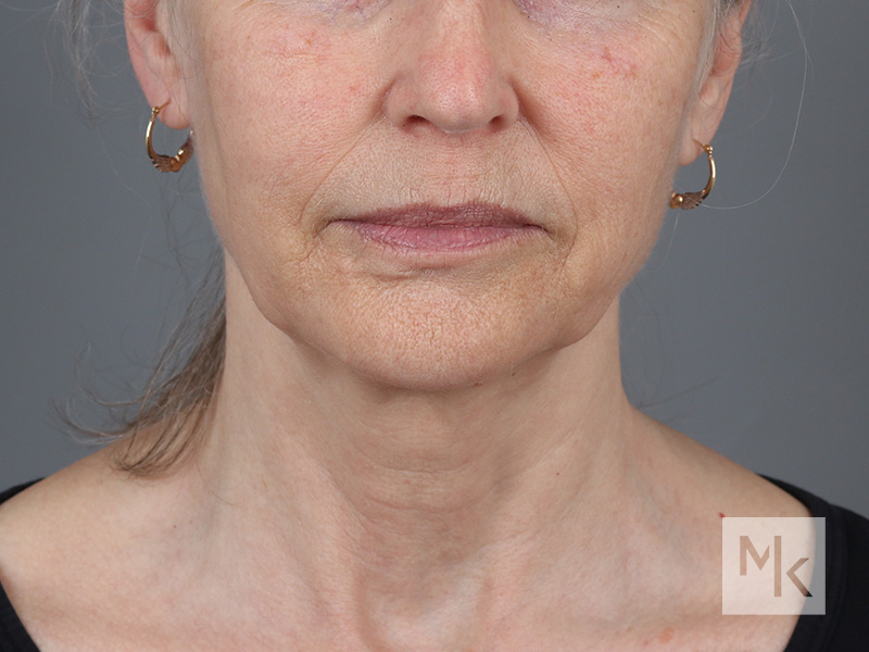 Facelift Before and After | Dr. Michael Kim