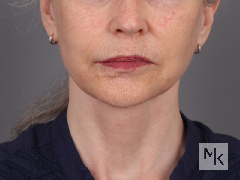 Facelift Before and After | Dr. Michael Kim