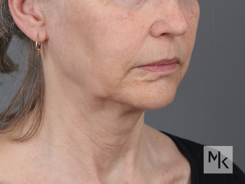 Facelift Before and After | Dr. Michael Kim