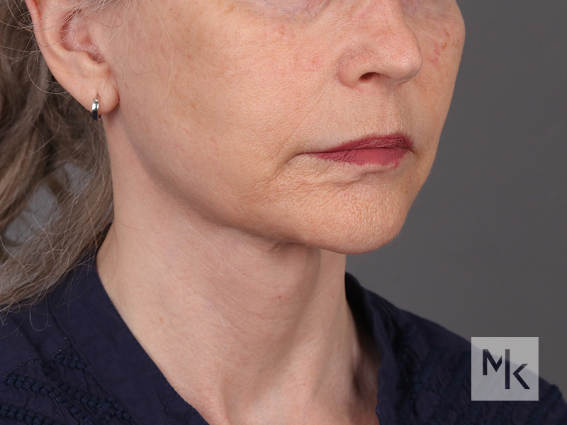 Facelift Before and After | Dr. Michael Kim