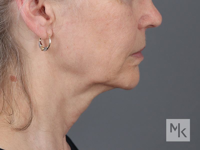 Facelift Before and After | Dr. Michael Kim